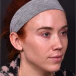 Atlanta chin implant best augmentation before after expert plastic surgery