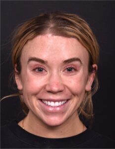 Atlanta lip lift bullhorn best surgery expert plastic before after deep plane