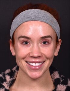 Atlanta lip lift bullhorn best surgery expert plastic before after deep plane
