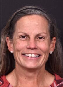 Aviva Atlanta forehead bump bone growth osteoma scarless best expert before after