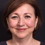 Atlanta blepharoplasty lid lift eyelid droopy best before after expert plastic surgery female woman surgeon deep plane facelift