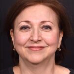 Atlanta blepharoplasty lid lift eyelid droopy best before after expert plastic surgery female woman surgeon deep plane facelift