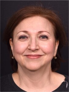 Atlanta blepharoplasty lid lift eyelid droopy best before after expert plastic surgery female woman surgeon deep plane facelift