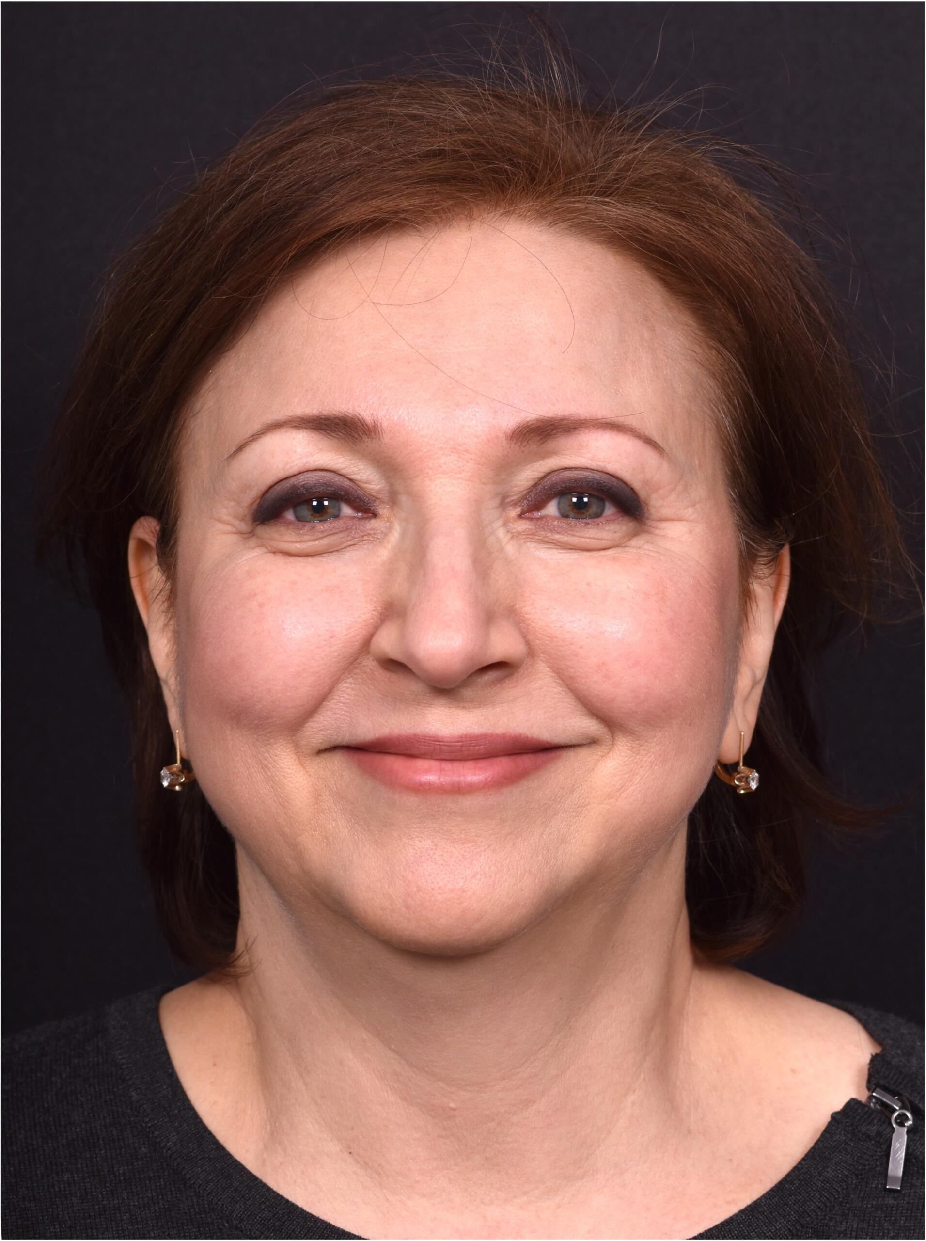 Atlanta blepharoplasty lid lift eyelid droopy best before after expert plastic surgery female woman surgeon deep plane facelift