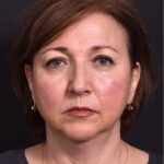 Atlanta blepharoplasty lid lift eyelid droopy best before after expert plastic surgery female woman surgeon deep plane facelift