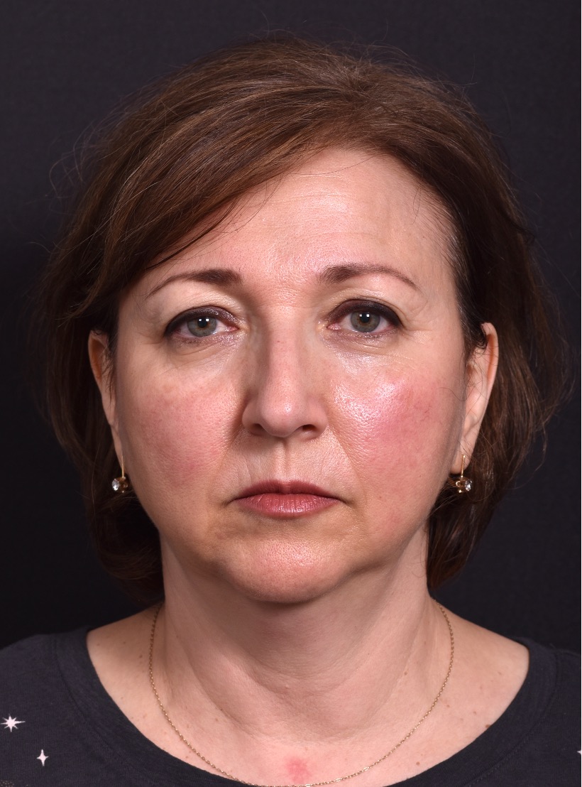 Atlanta blepharoplasty lid lift eyelid droopy best before after expert plastic surgery female woman surgeon deep plane facelift