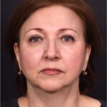 Atlanta blepharoplasty lid lift eyelid droopy best before after expert plastic surgery female woman surgeon deep plane facelift