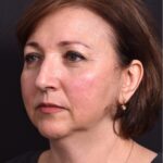 Atlanta blepharoplasty lid lift eyelid droopy best before after expert plastic surgery female woman surgeon deep plane facelift