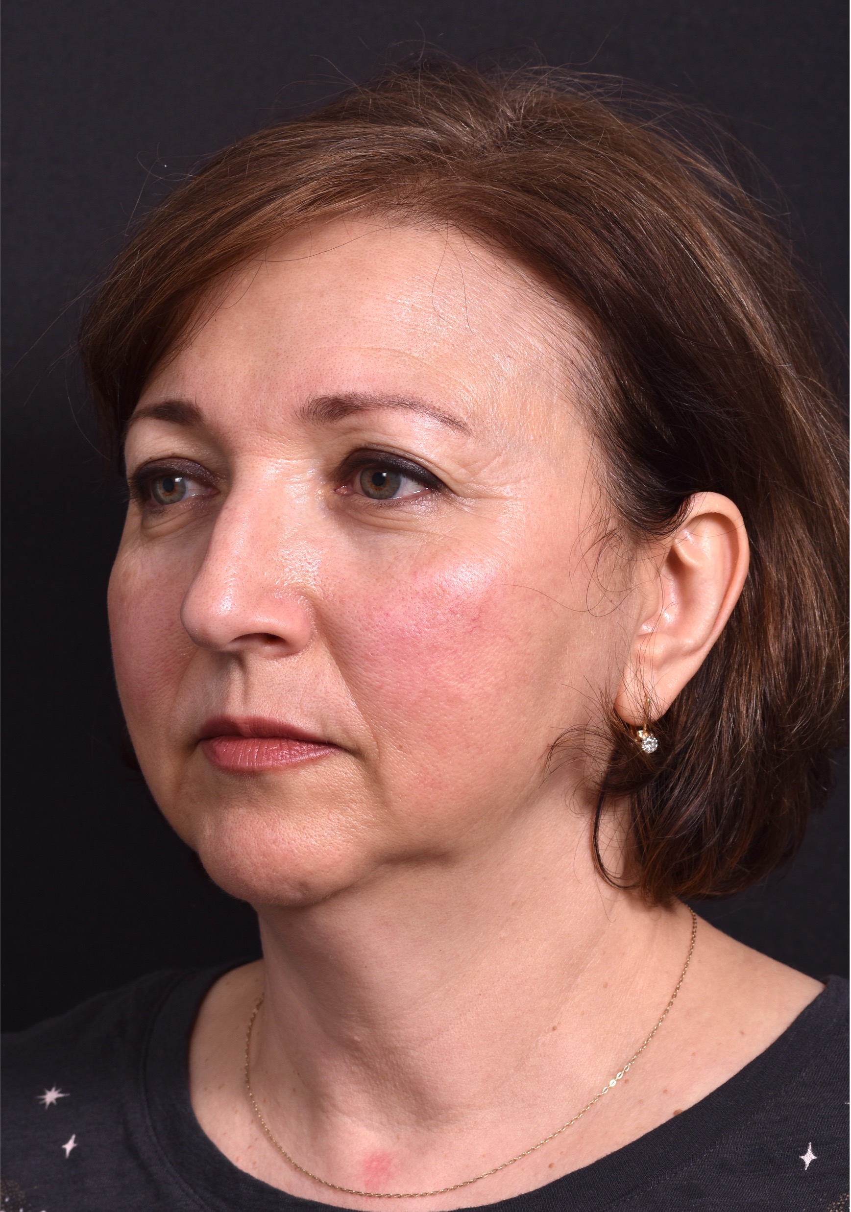 Atlanta blepharoplasty lid lift eyelid droopy best before after expert plastic surgery female woman surgeon deep plane facelift