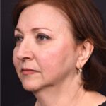 Atlanta blepharoplasty lid lift eyelid droopy best before after expert plastic surgery female woman surgeon deep plane facelift