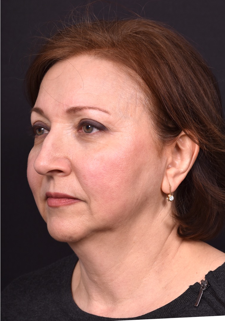 Atlanta blepharoplasty lid lift eyelid droopy best before after expert plastic surgery female woman surgeon deep plane facelift