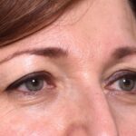 Atlanta blepharoplasty lid lift eyelid droopy best before after expert plastic surgery female woman surgeon deep plane facelift