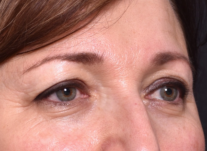 Atlanta blepharoplasty lid lift eyelid droopy best before after expert plastic surgery female woman surgeon deep plane facelift