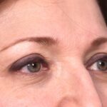 Atlanta blepharoplasty lid lift eyelid droopy best before after expert plastic surgery female woman surgeon deep plane facelift