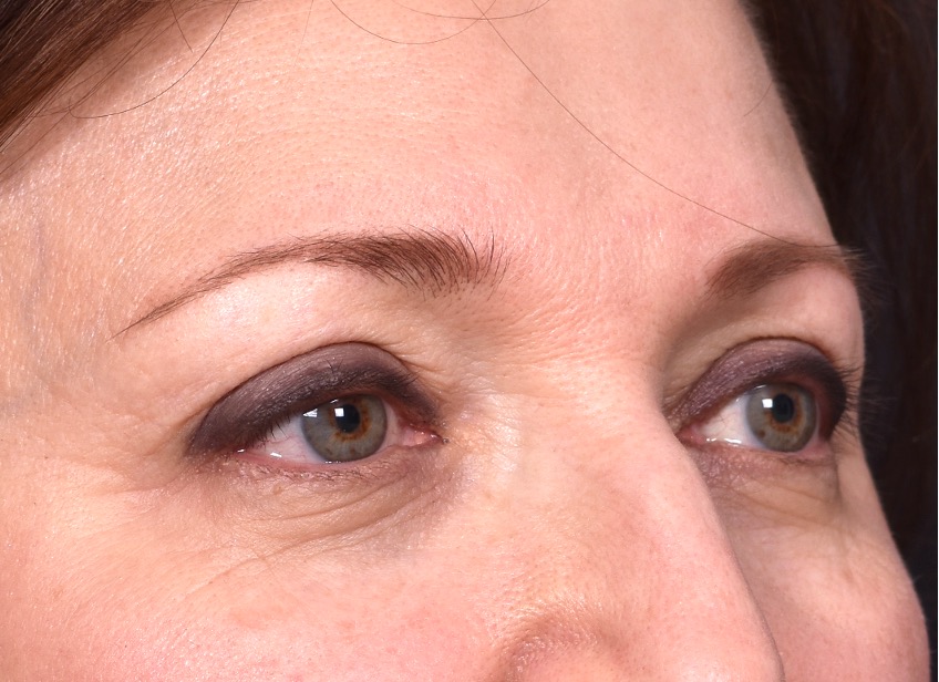 Atlanta blepharoplasty lid lift eyelid droopy best before after expert plastic surgery female woman surgeon deep plane facelift