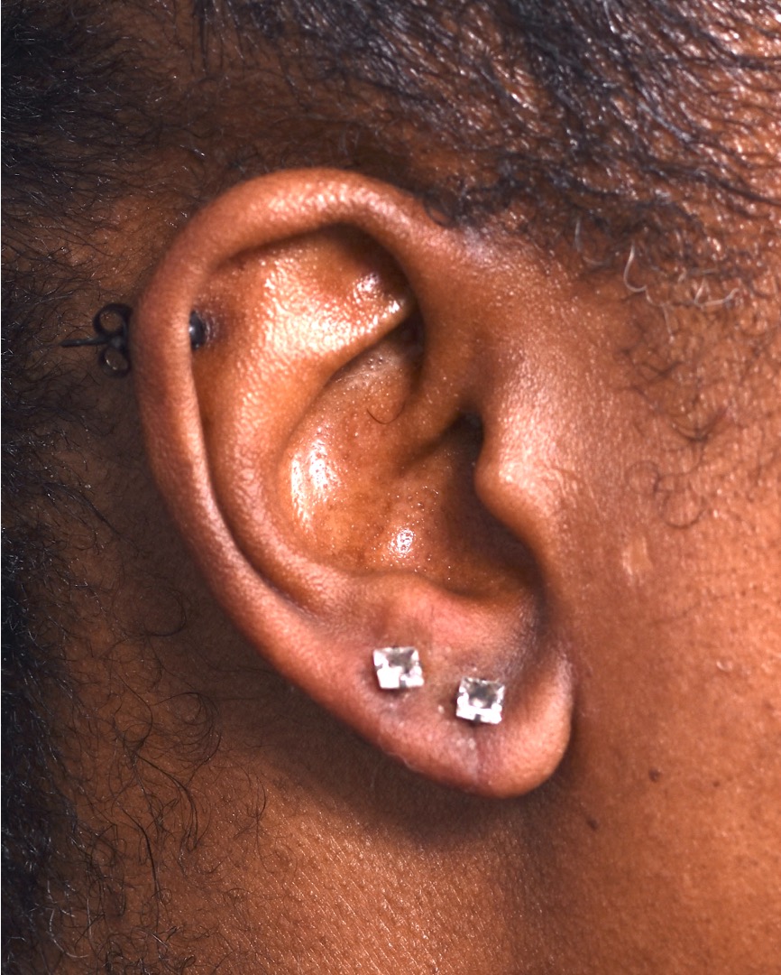 Aviva Atlanta earlobe repair surgery stretched torn piercing ear otoplasty best near me