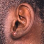 Aviva Atlanta keloid treatment surgery scar therapy best expert results near me