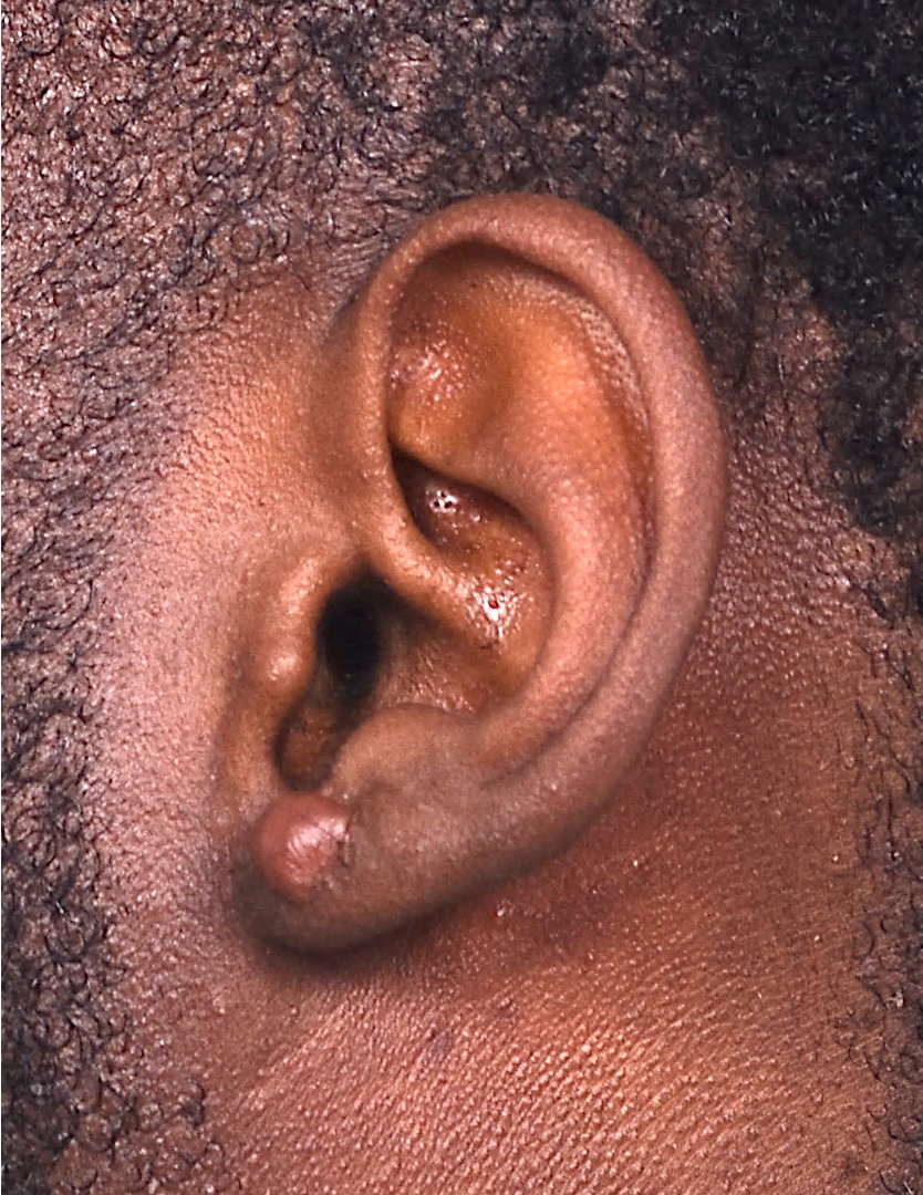 Aviva Atlanta keloid treatment surgery scar therapy best expert results near me