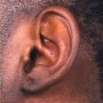 Aviva Atlanta keloid treatment surgery scar therapy best expert results near me