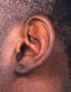 Aviva Atlanta keloid treatment surgery scar therapy best expert results near me