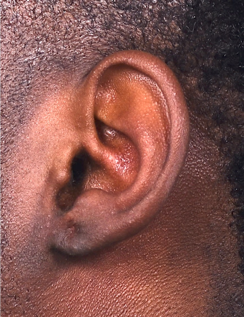 Aviva Atlanta keloid treatment surgery scar therapy best expert results near me