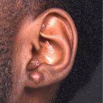 Aviva Atlanta keloid treatment surgery scar therapy best expert results near me