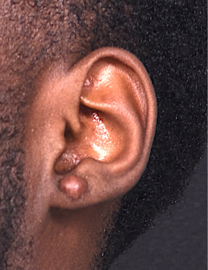 Aviva Atlanta keloid treatment surgery scar therapy best expert results near me