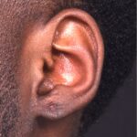 Aviva Atlanta keloid treatment surgery scar therapy best expert results near me