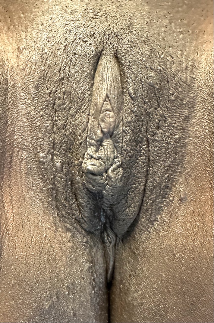 Aviva labiaplasty Atlanta near me clitoral hood reduction best before after results recovery expert cosmetic gynecology female