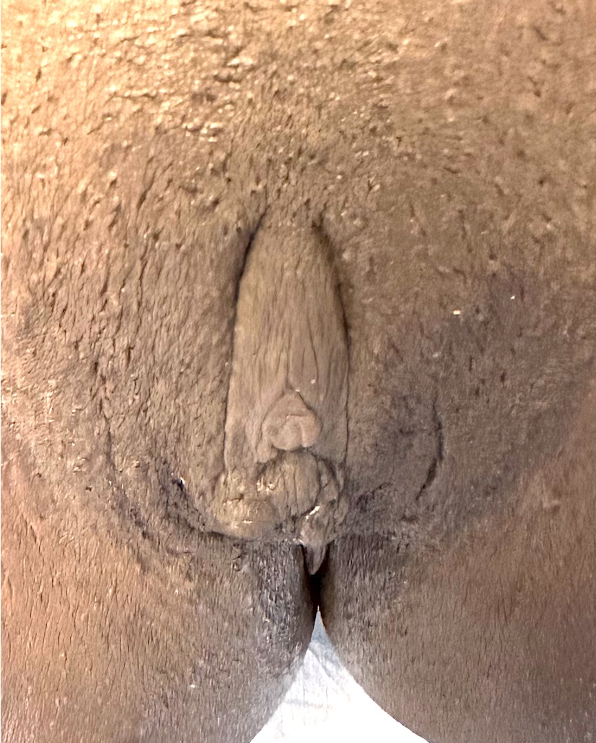 Atlanta labiaplasty Aviva best expert near me recovery results plastic surgery