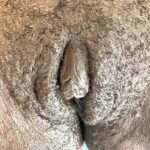 Atlanta labiaplasty Aviva best expert near me recovery results plastic surgery before after surgery cosmetic gynecology