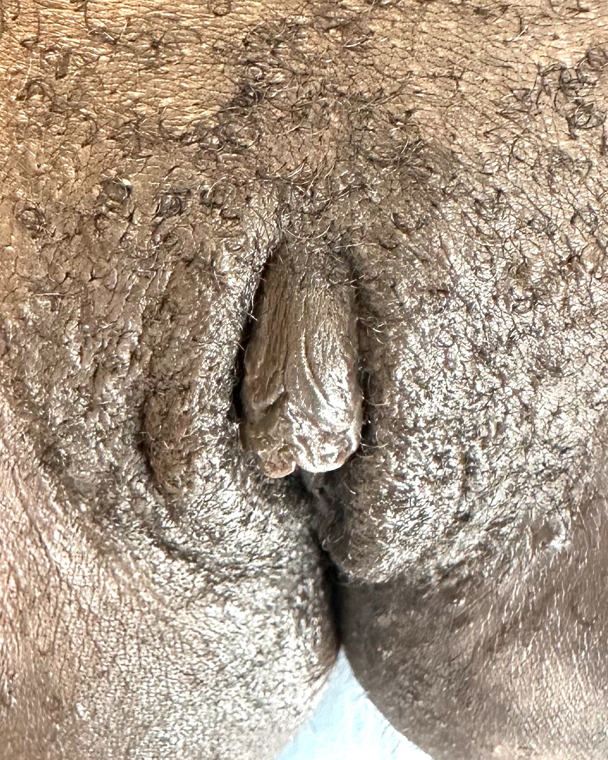 Atlanta labiaplasty Aviva best expert near me recovery results plastic surgery before after surgery cosmetic gynecology