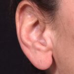 Earlobe reduction too long surgery plastic expert otoplasty best near me Atlanta female