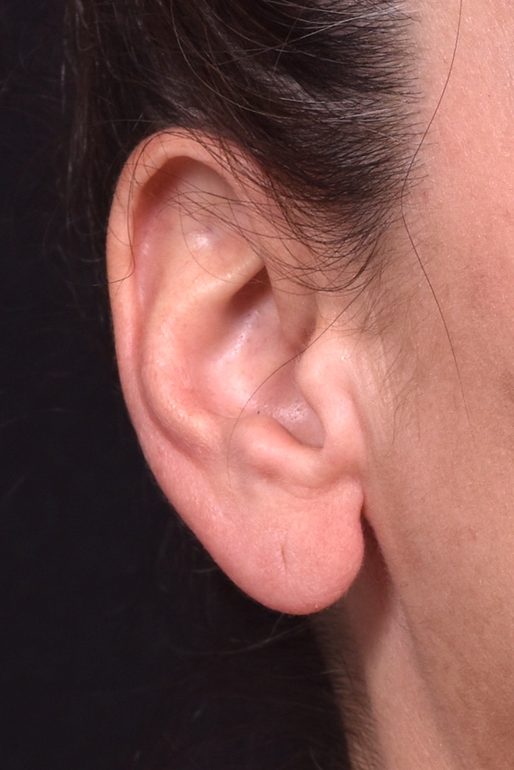 Earlobe reduction too long surgery plastic expert otoplasty best near me Atlanta female
