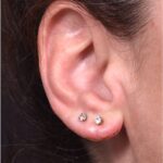 Earlobe reduction too long surgery plastic expert otoplasty best near me Atlanta female