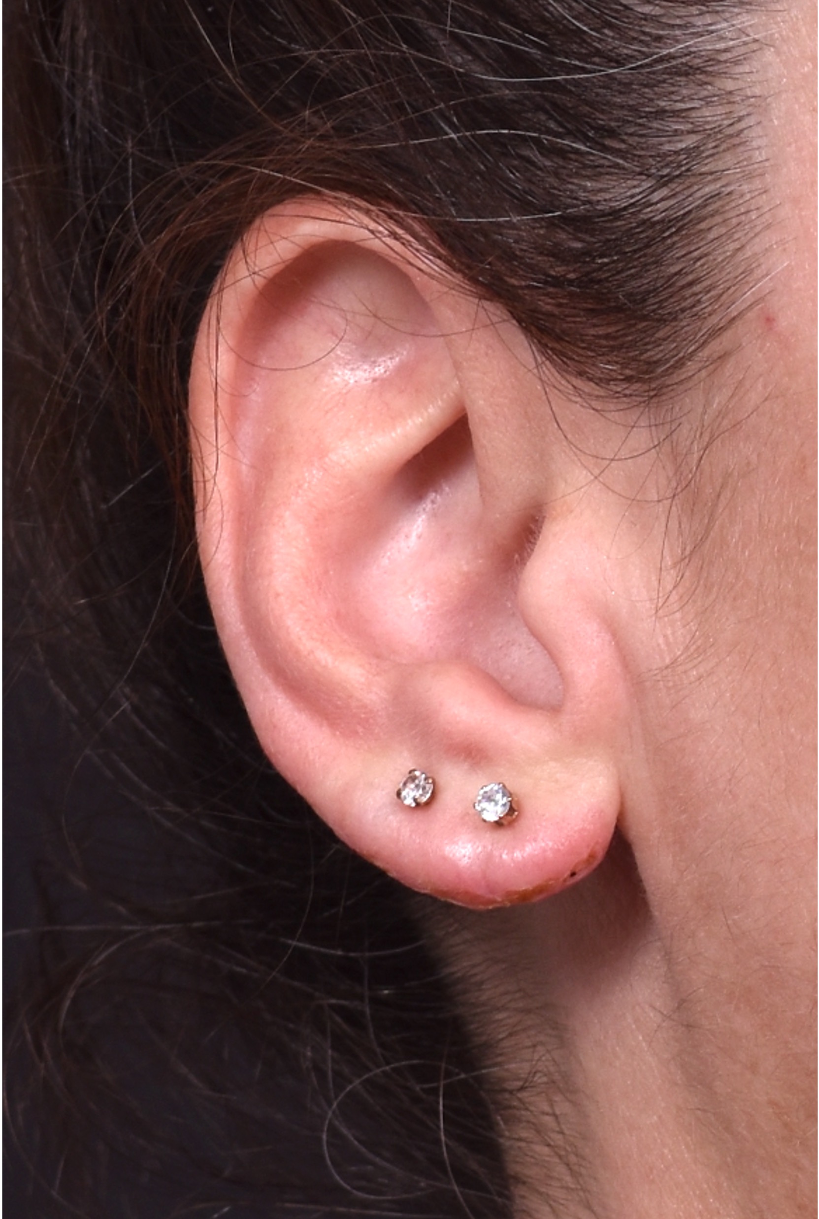 Earlobe reduction too long surgery plastic expert otoplasty best near me Atlanta female