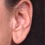 Earlobe reduction too long surgery plastic expert otoplasty best near me Atlanta female