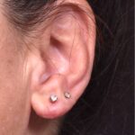 Earlobe reduction too long surgery plastic expert otoplasty best near me Atlanta female