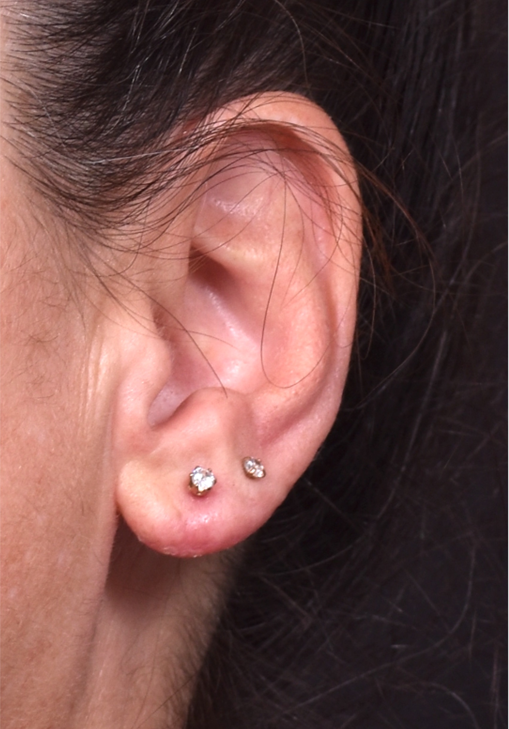 Earlobe reduction too long surgery plastic expert otoplasty best near me Atlanta female