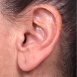 Earlobe reduction too long surgery plastic expert otoplasty best near me Atlanta female