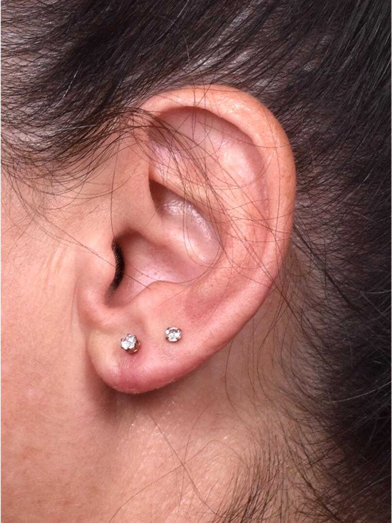 Earlobe reduction too long surgery plastic expert otoplasty best near me Atlanta female