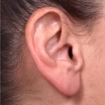 Earlobe reduction too long surgery plastic expert otoplasty best near me Atlanta female