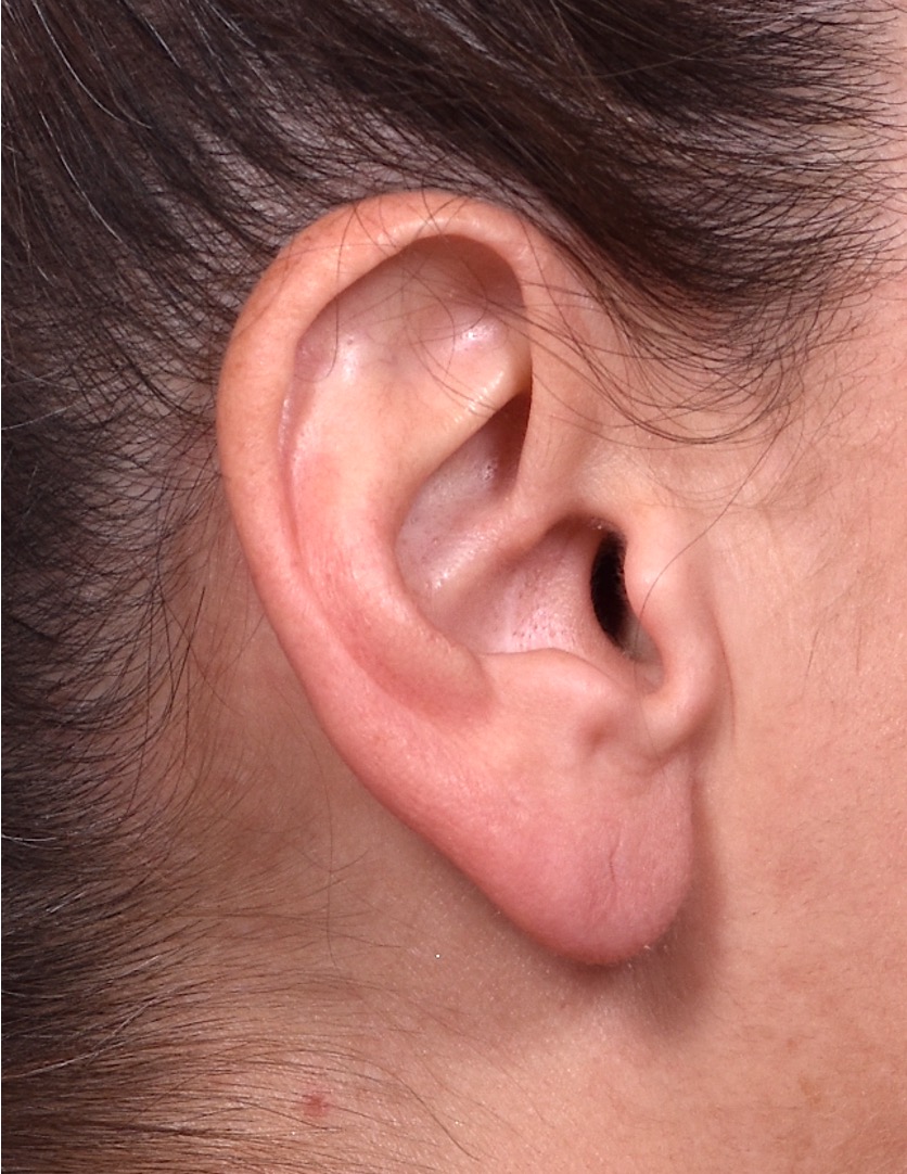 Earlobe reduction too long surgery plastic expert otoplasty best near me Atlanta female