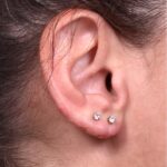 Earlobe reduction too long surgery plastic expert otoplasty best near me Atlanta female