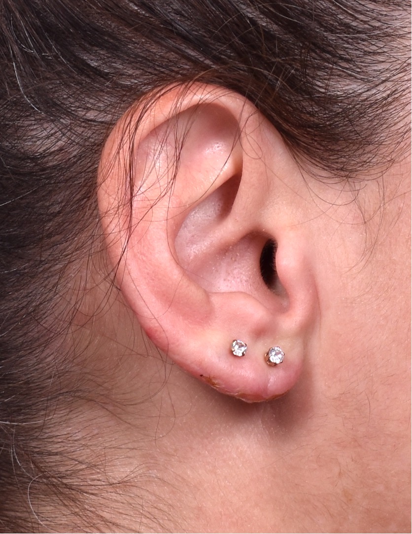 Earlobe reduction too long surgery plastic expert otoplasty best near me Atlanta female