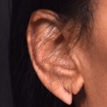 Torn earlobe piercing stretched Atlanta repair surgery ear best near me