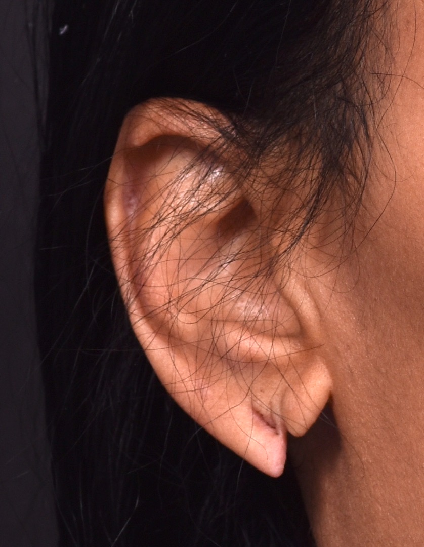 Torn earlobe piercing stretched Atlanta repair surgery ear best near me