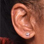 Torn earlobe piercing stretched Atlanta repair surgery ear best near me