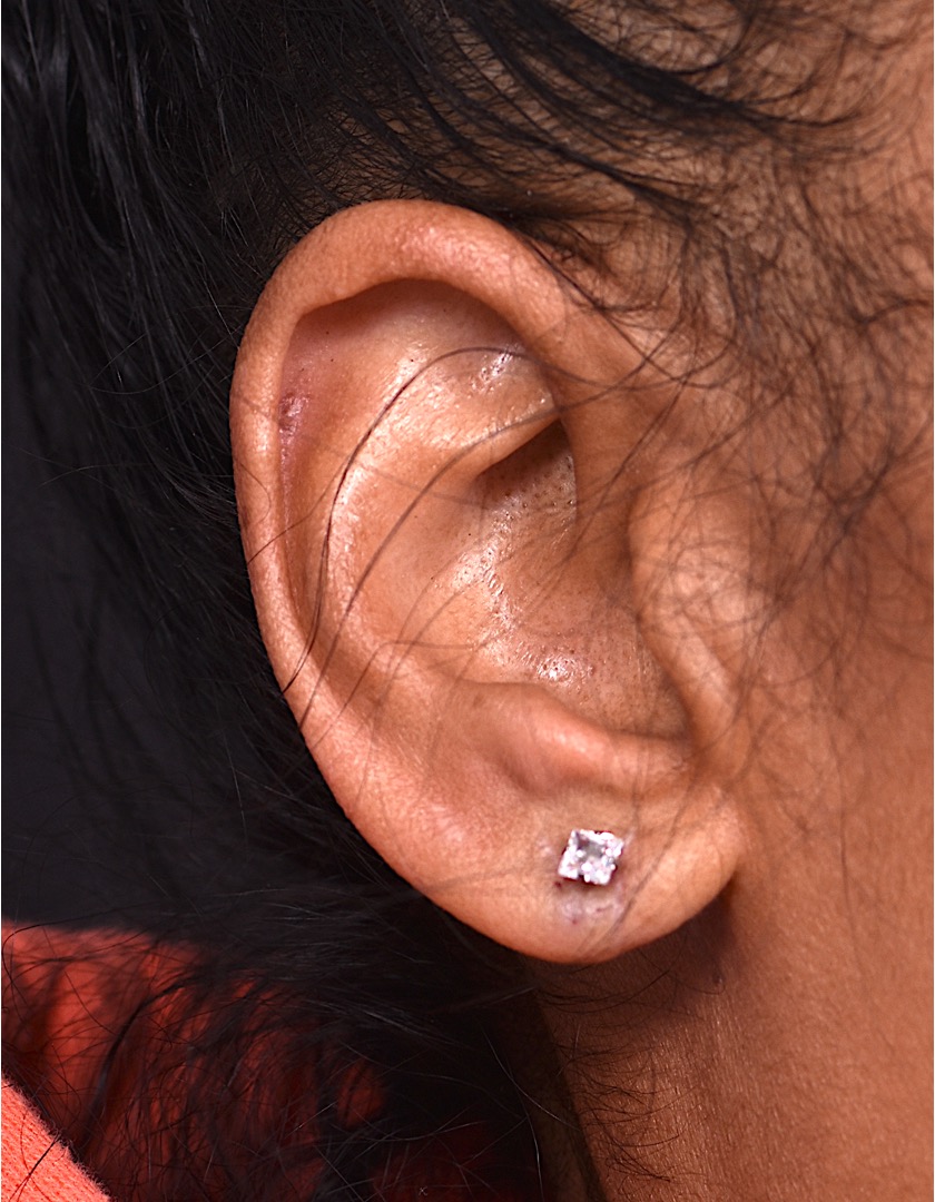 Torn earlobe piercing stretched Atlanta repair surgery ear best near me