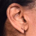 Torn earlobe piercing stretched Atlanta repair surgery ear best near me